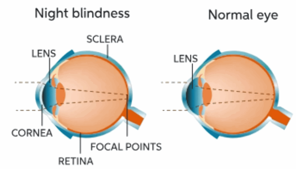 Night Blindness