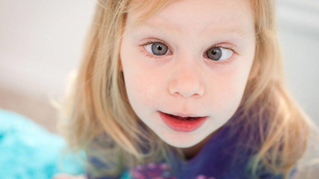 Squint in Children