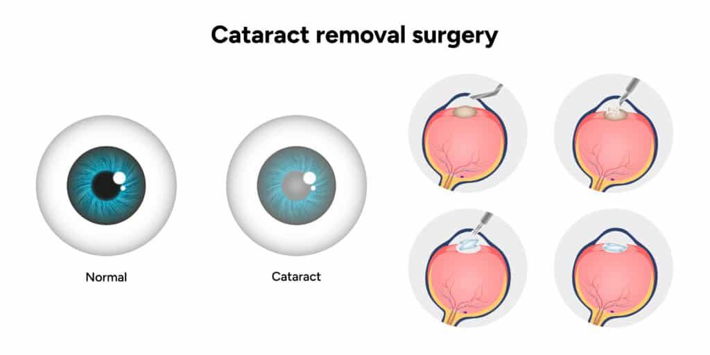 Types of Cataract Surgery